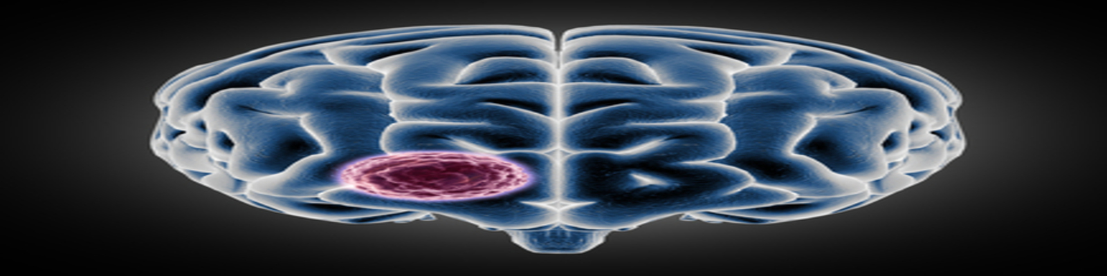 brain highlighting tumour symptoms